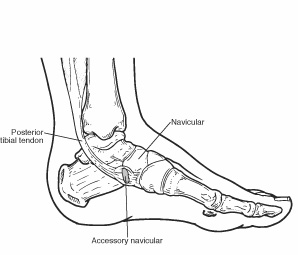Foot diagram indicating location of posterior tibial tendon, accessory navicular, and navicular