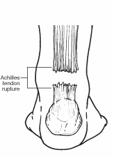 Diagram of the back of the leg indicating site of Achilles tendon rupture