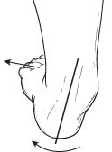 Flatfoot entails partial or total collapse (loss) of the arch
