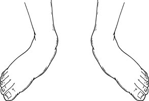 Pediatric flatfoot deformity as seen from the front.