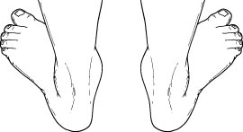 Pediatric flatfoot deformity as seen from the back.