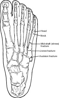 Fifth metatarsal fracture locations