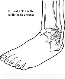 Injured ankle with laxity of ligaments