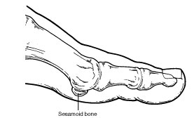 Sesamoid bone in foot