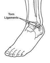 Diagram of torn ligaments in a sprained ankle