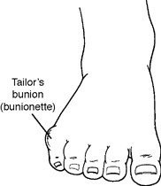 Location of Tailor's Bunion (Bunionette)