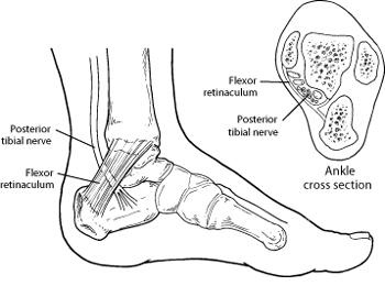Diagram of where Tarsal Tunnel Syndrome occurs