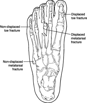 Locations of displaced and nondisplaced toe fractures