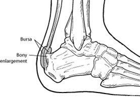 Haglund's deformity is a bony enlargement on the back of the heel