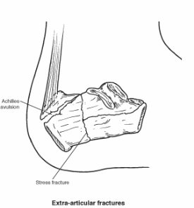 Extra-articular calcaneal fracture