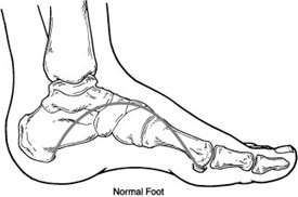 Normal foot without Charcot deformity