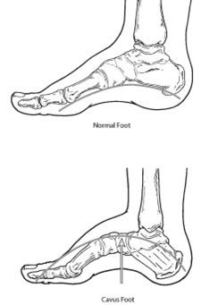Normal foot and Cavus foot