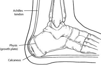 Diagram of foot indicating calcaneus as related to calcaneal apophysitis