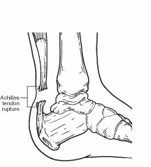 Diagram of foot indicating location of achilles tendon tear
