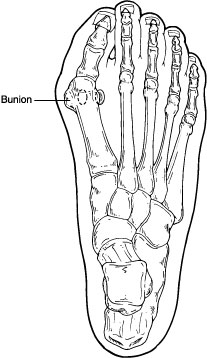 Diagram indicating location of bunion on a foot