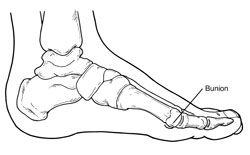 Diagram indicating location of bunion on a foot