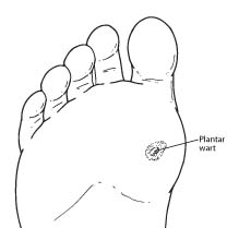 foot verruca causes
