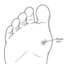 Plantar wart