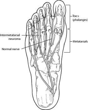 Symptoms of Morton's Neuroma