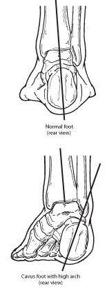 Normal foot and Cavus foot