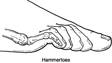 Hammertoes