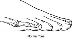 Normal toes unaffected by hammertoe