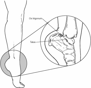 Diagram of Os Trigonum