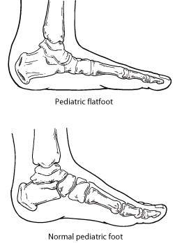 Pediatric flatfoot and normal pediatric foot