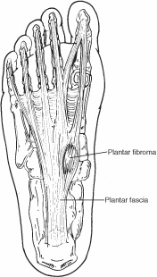 Plantar fibroma