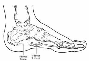 plantar fibroma pain