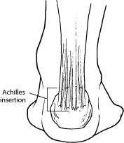 Diagram of the back of the foot indicating location of the achilles tendon insertion point