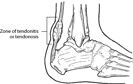 Diagram of side of foot showing zone of tendonitis or tendonosis