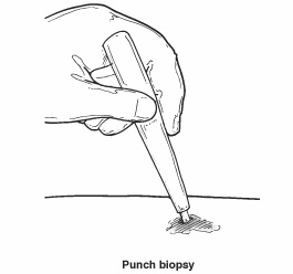 Punch biopsy