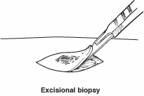 Excisional biopsy