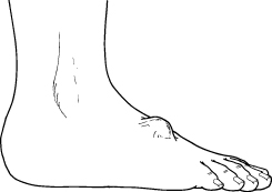 Ganglion Cyst Foot Ganglion Cyst Treatment Foot Health Facts Foot Health Facts Ganglion Cyst Foot Ganglion Cyst Treatment Foot Health Facts Foot Health Facts