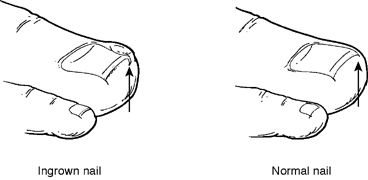 Ingrown Toenails in Children - Foot Health Facts