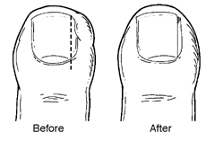 Ingrown toenail before and after treatment