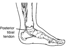 Adult Acquired Flatfoot Deformity