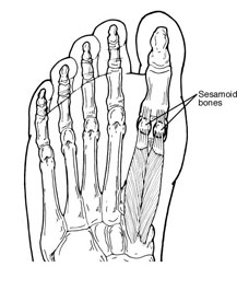 Sesamoid in the foot