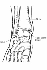 Diagram of Talar Dome Lesion