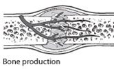 Diagram of bone production during bone healing
