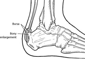 Diagram of Haglund's Deformity