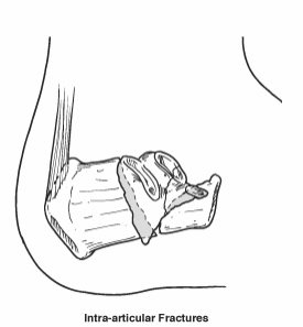 Intra-articular calcaneal fracture