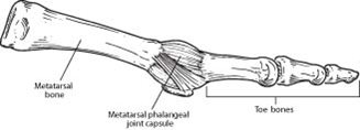 Capsulitis of the second toe