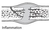 Diagram of inflammation in a fractured bone
