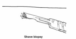 Shave biopsy