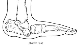 Charcot foot showing rocker-bottom foot deformity